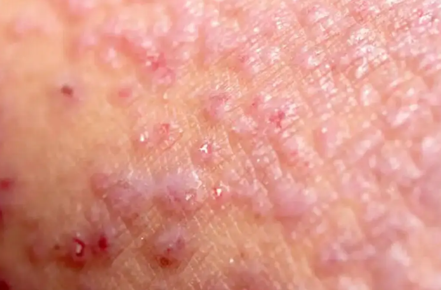 Veracruz registra seis casos de Mpox en 2024